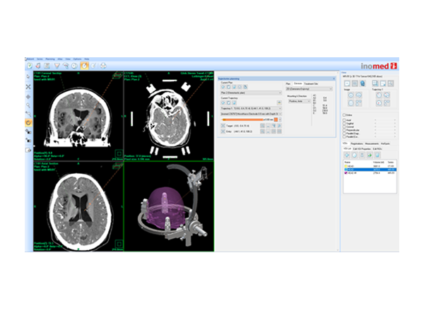 inomed Planungs&shy;software iPS für 3D-Stereotaxie-Anwendungen